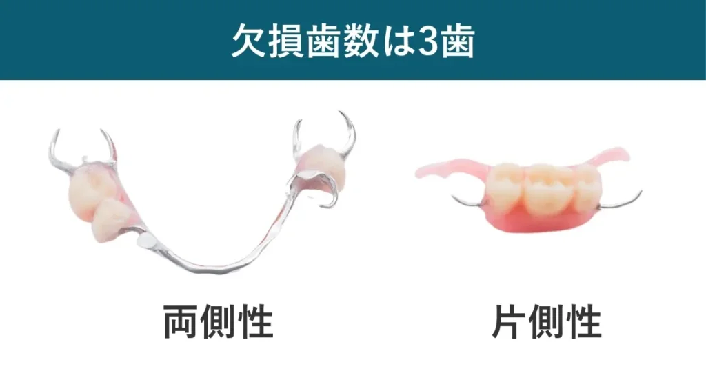 欠損歯数は同じでも、欠損部位の違いにより、片側性と両側性に分けられます。