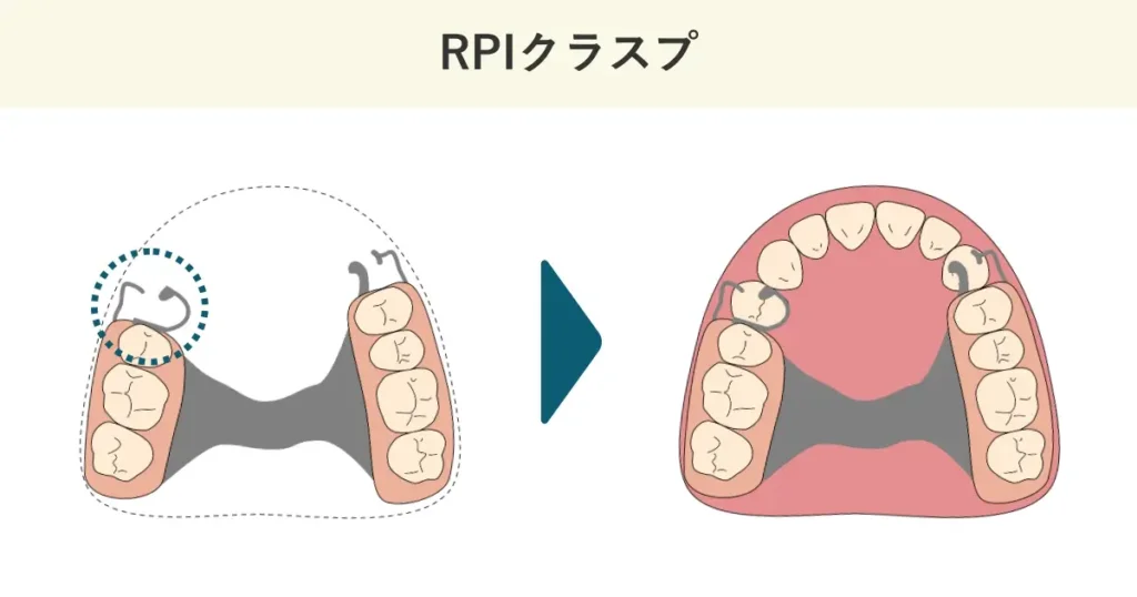 RPIクラスプの模式図です。