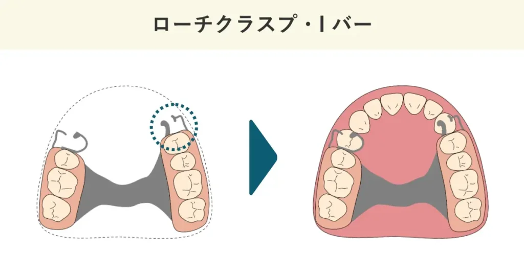 ローチクラスプ・Iバーの模式図です。