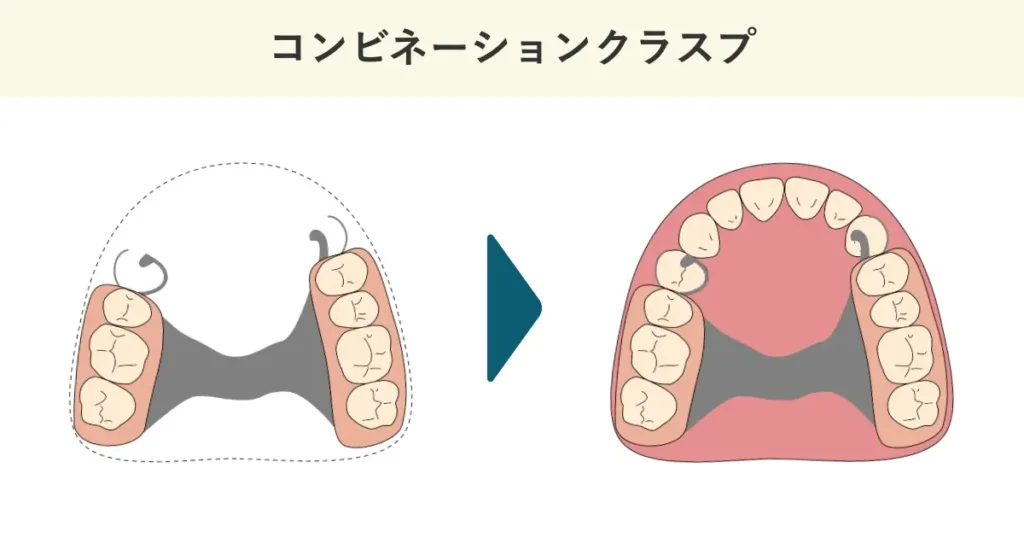 コンビネーションクラスプの模式図です。