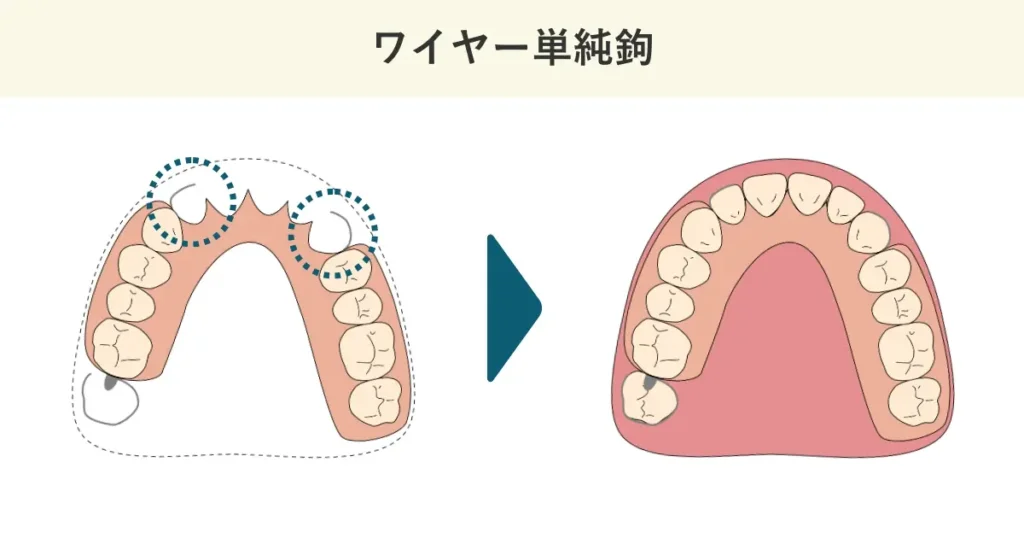 ワイヤー単純鉤の模式図です。