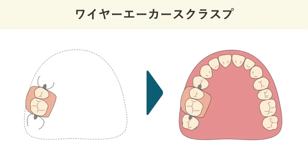 ワイヤーエーカースクラスプの模式図です。