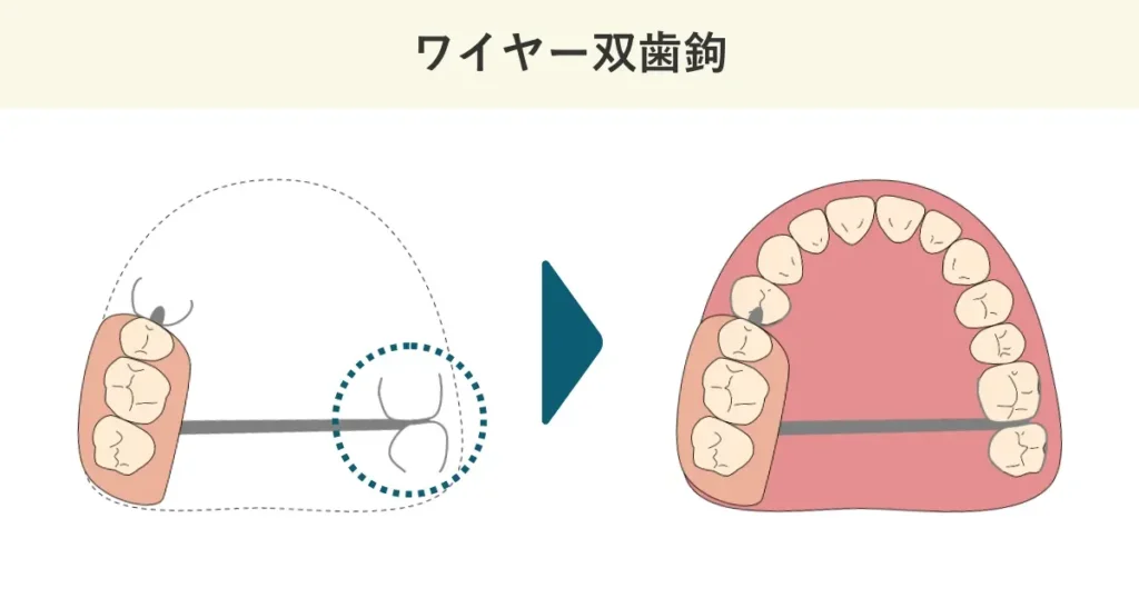 ワイヤー双歯鉤の模式図です。