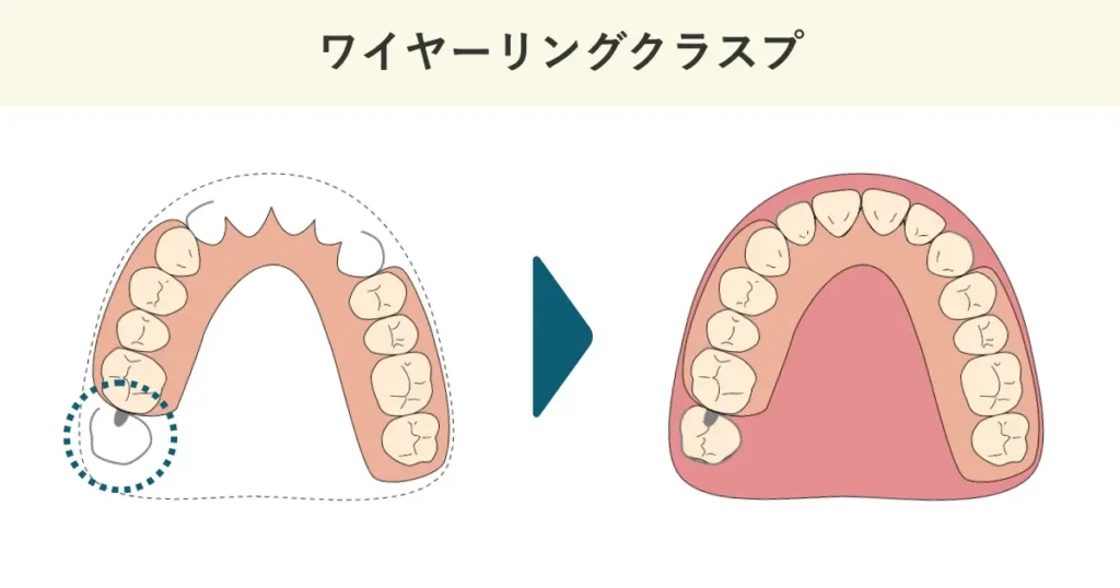 ワイヤーリングクラスプの模式図です。