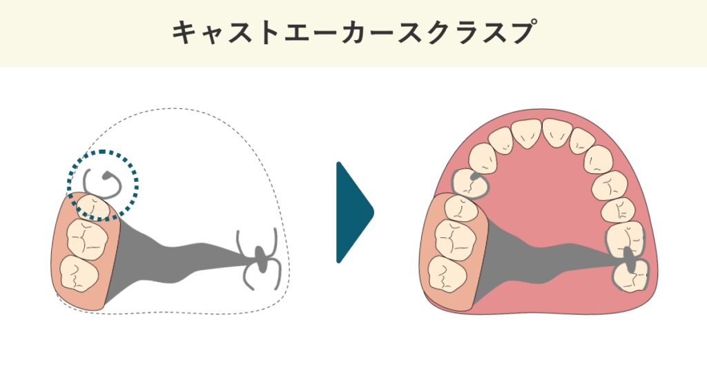 キャストエーカースクラスプの模式図です。
