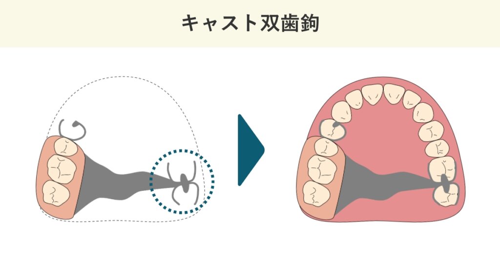 キャスト双歯鉤の模式図です。