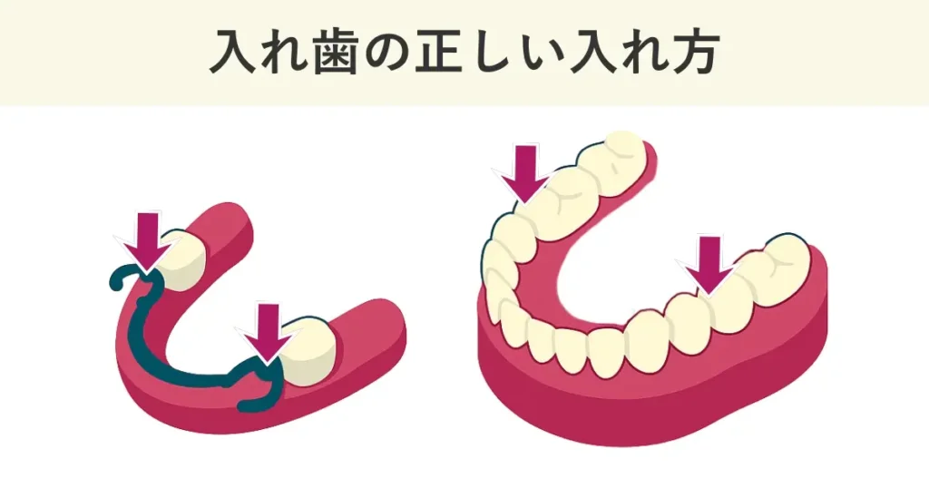 部分入れ歯の正しい入れ方は、レストを垂直に押し込みます。総入れ歯の正しい入れ方は奥歯部分を垂直に押し込みます。