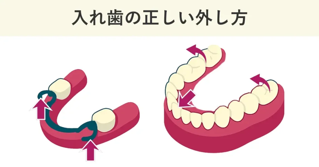 部分入れ歯の正しい外し方は、クラスプを持ち上げます。総入れ歯の正しい外し方は、前歯部分を手前に倒し、後方を持ち上げるようにして外します。