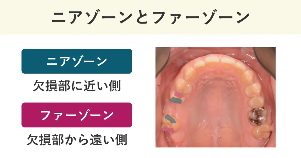 ニアゾーンは欠損部に近い側、ファーゾーンは欠損部から遠い側です。