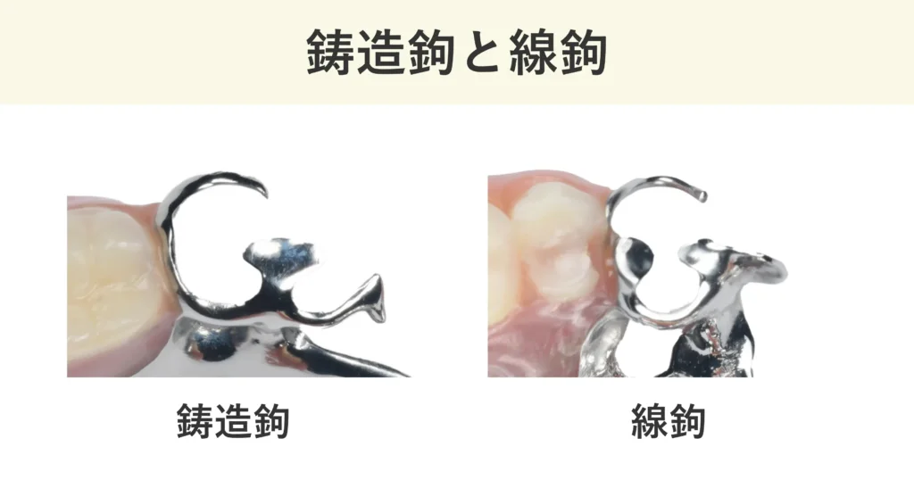 鋳造鉤（キャストクラスプ）と線鉤（ワイヤークラスプ）の違い