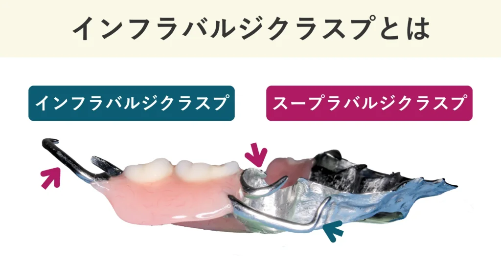 クラスプにはインフラバルジクラスプとスープラバルジクラスプがあります。