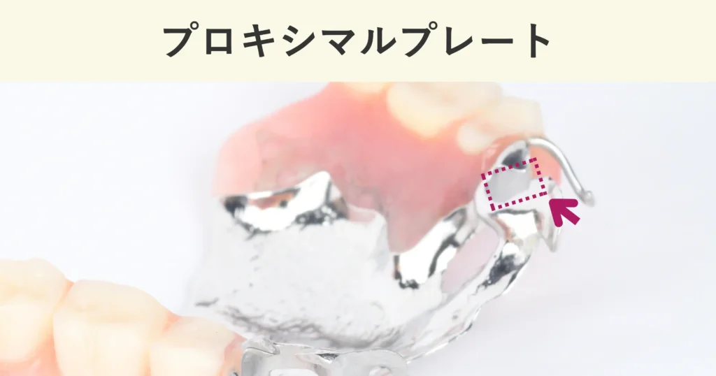 エーカースクラスプのプロキシマルプレート