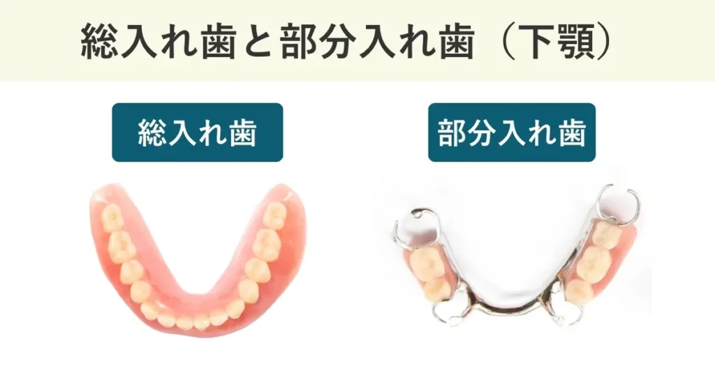 総入れ歯と部分入れ歯の見分け方