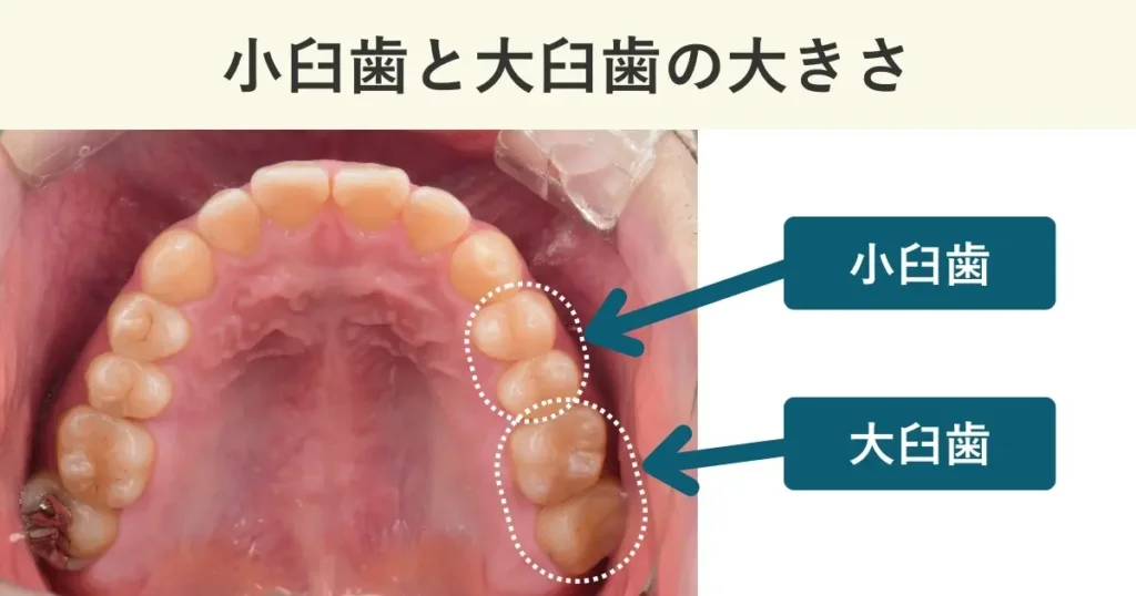 臼歯の大きさによる入れ歯の見分け方